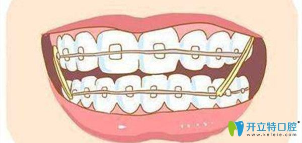 牙齒矯正時(shí)間的長(zhǎng)短與那些因素有關(guān)