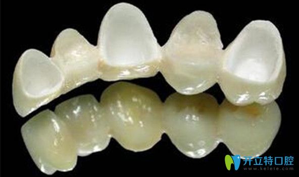 選擇單冠或連冠需聽(tīng)取醫(yī)生建議