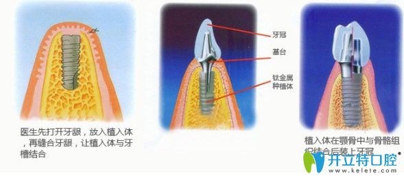 中山美南華牙科主任江會昇解說種植牙術(shù)后注意事項