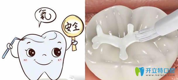 窩溝封閉和涂氟的區(qū)別