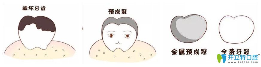 兒童乳牙預成冠是什么？比樹脂填充好在哪里？