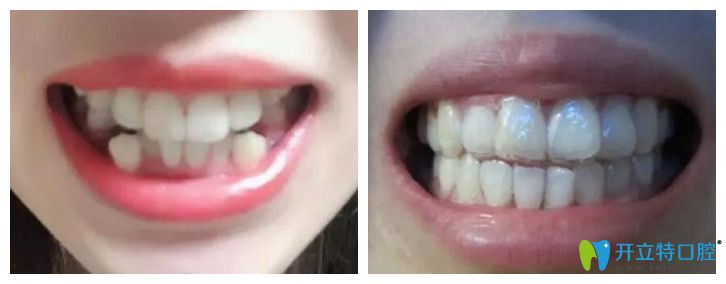 廣州壹加壹口腔牙齒擁擠矯正實例