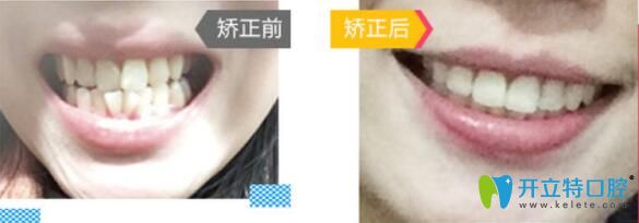 廣州哪里做牙齒正畸好？來看廣大口腔牙齒矯正前后對比圖
