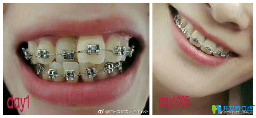 牙齒擁擠不齊，個(gè)別反頜小姐姐也來(lái)打卡啦