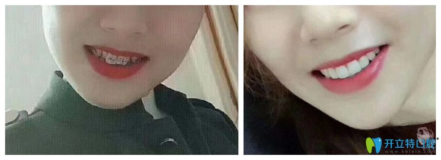 壹加壹門(mén)牙是兔牙的顧客矯正案例