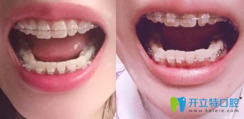 杭州時(shí)光口腔陶瓷托槽牙齒矯正一年照