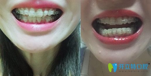 杭州時(shí)光口腔矯正牙齒深覆蓋4個(gè)月照