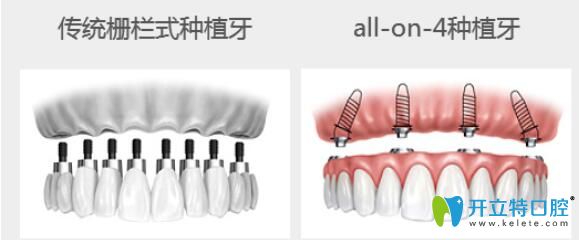 曲獻民科普：All-on-four全口種植優(yōu)勢體
