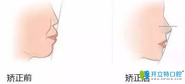 齙牙矯正前后對比圖