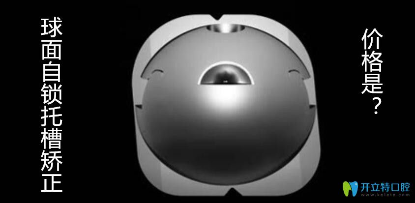 球面自鎖托槽OBrace矯正的價(jià)格是多少