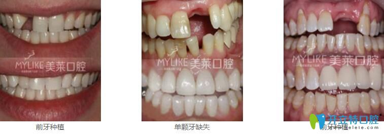 深圳種植牙哪家好？來看美萊口腔真人種植牙案例效果對比圖