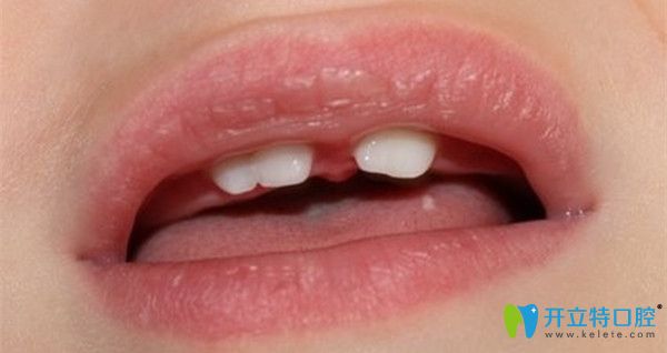 導致融合牙的因素有哪些