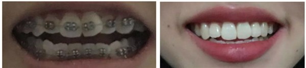 福州正畸多少錢?我在艾尚美口腔做矯正花了1.5萬(wàn)元,效果不錯(cuò)