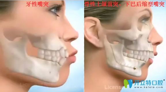 牙性突嘴和骨性上頜前突下巴后縮嘴突對比照