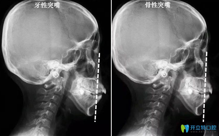 骨性突嘴和牙性凸嘴判斷對比圖
