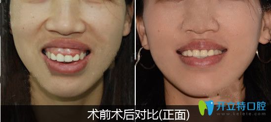 骨性突嘴選擇正頜正畸聯(lián)合治療改善后對比圖