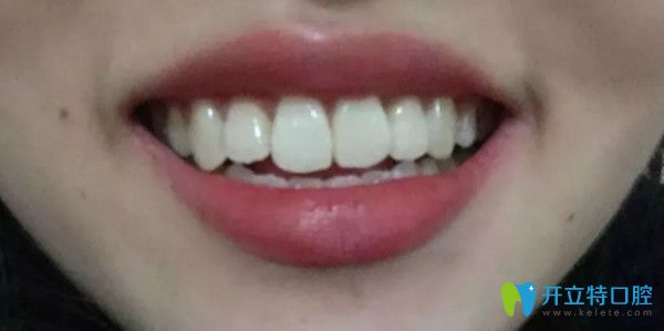 牙齒矯正前后對比圖 牙齒矯正前后對比圖