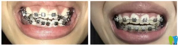 牙齒正畸前后對比照 牙齒正畸前后對比照