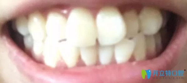 矯正前牙齒的情況 矯正前牙齒的情況