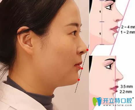 無錫佳士潔口腔賈艷講解正畸中的面部美學(xué)參考