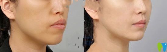 牙性突嘴做完牙齒矯正后的對比照