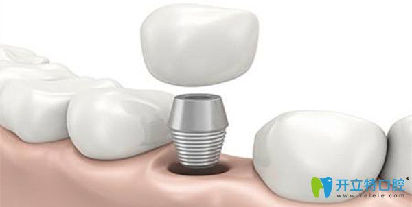 牙齒缺失修復(fù)選擇種植牙