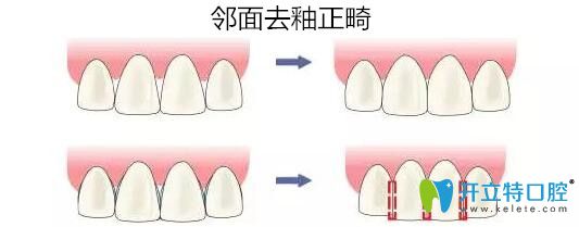 鄰面去釉正畸效果