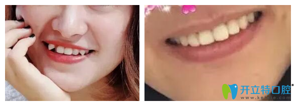 長(zhǎng)春超龍牙博士口腔隱形牙齒矯正案例