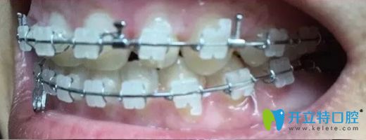 北京康貝佳口腔陶瓷牙套正畸7個月牙齒側(cè)面效果圖