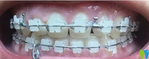北京康貝佳口腔牙齒矯正7個月效果變化圖