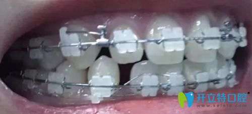 北京康貝佳口腔剛戴牙套時牙齒稀疏的照片