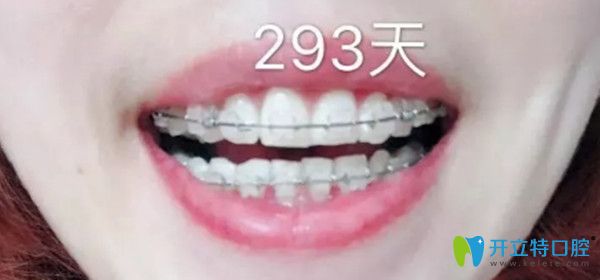 半隱形托槽前后對比照