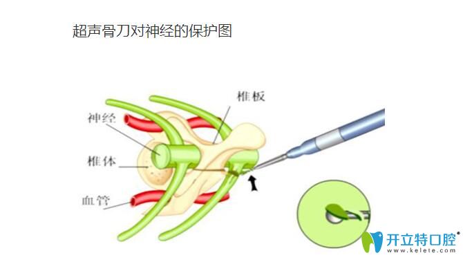 超聲骨刀拔牙有什么特點