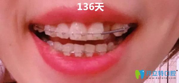 在<!--<i data=20240703-sp></i>-->美維口腔做矯正第136天
