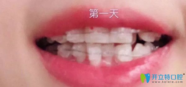 剛帶上牙套的第1天