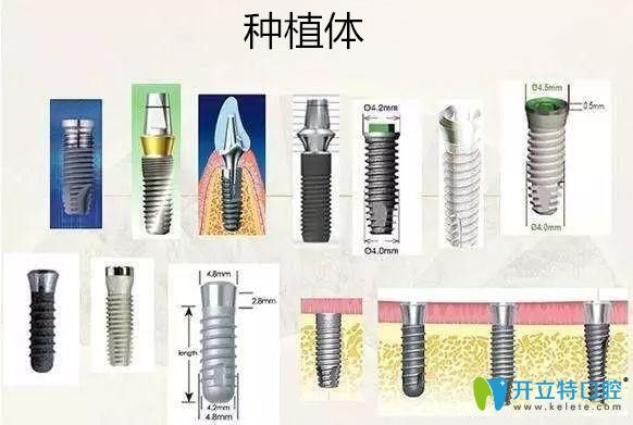  談?wù)劮N植牙價格便宜和貴的有什么區(qū)別？