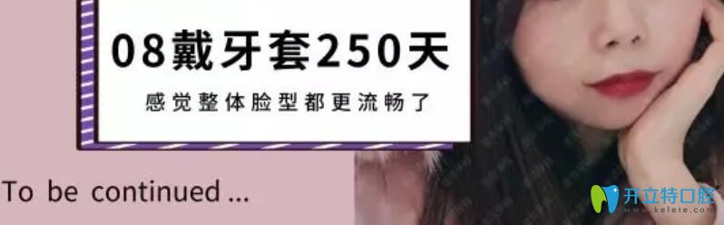 擁擠牙齒在圣貝口腔矯正250天照片