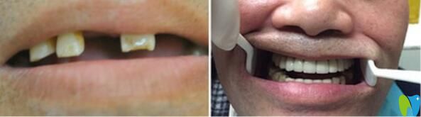 <!--<i data=20240703-sp></i>-->口腔全口牙即刻負重種植案例前后效果對比