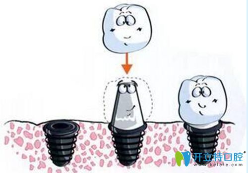 種植牙掉了還能再種嗎