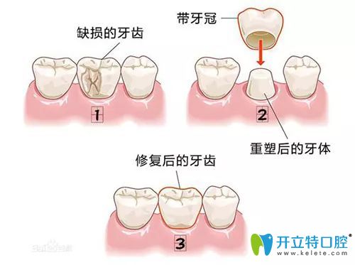 重慶維樂(lè)口腔王鳳醫(yī)生介紹全瓷冠修復(fù)優(yōu)勢(shì)