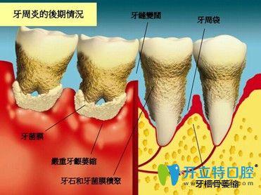 重慶維樂口腔楊彬醫(yī)生介紹牙周病治療方法