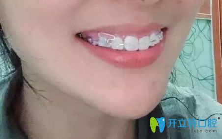 摘掉牙套的我已經(jīng)戴上了保持器