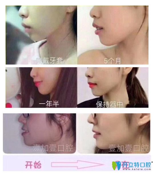廣州壹加壹口腔牙齒矯正實例療效對比圖