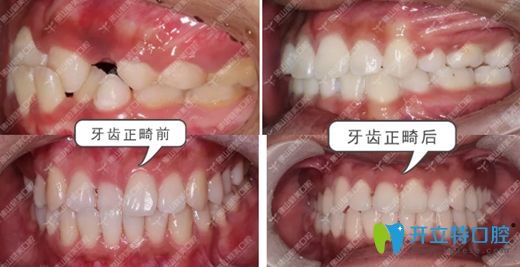佛山春芽口腔鄭旭輝牙齒矯正前后效果圖