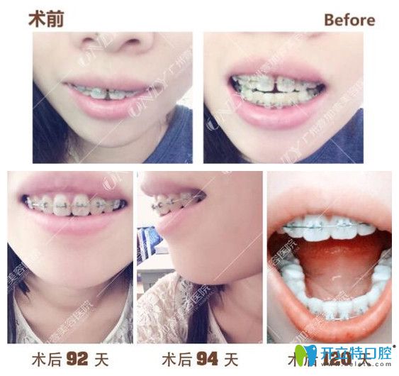 壹加壹齙牙，門牙縫隙矯正過(guò)程中牙齒變化圖