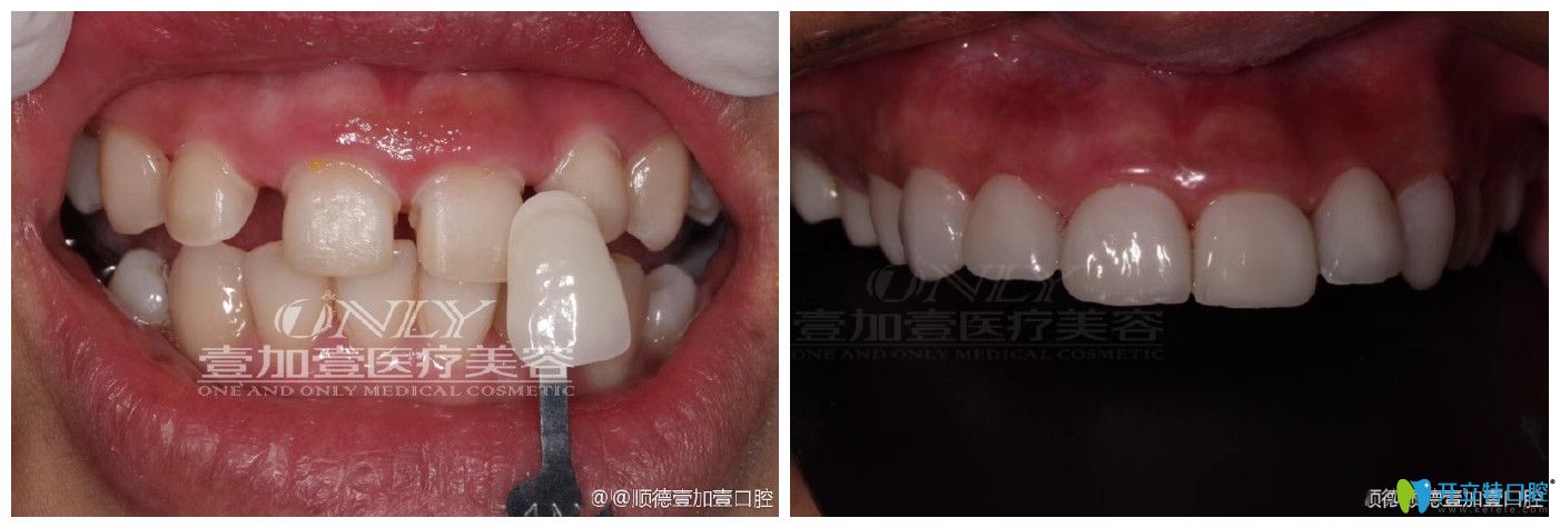 佛山順德壹加壹口腔牙貼面修復(fù)牙齒縫隙大案例前后效果對比