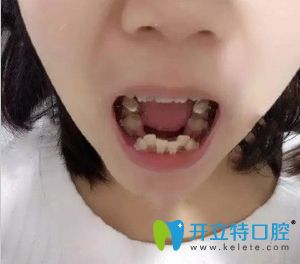 順德壹加壹口腔陶瓷托槽矯正齙牙術(shù)中照