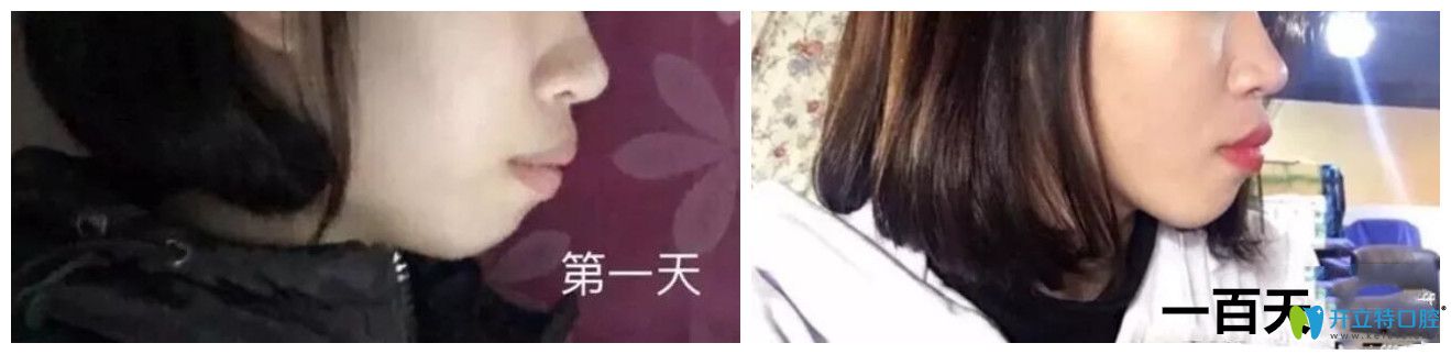 牙齒矯正過(guò)程中側(cè)臉變化圖