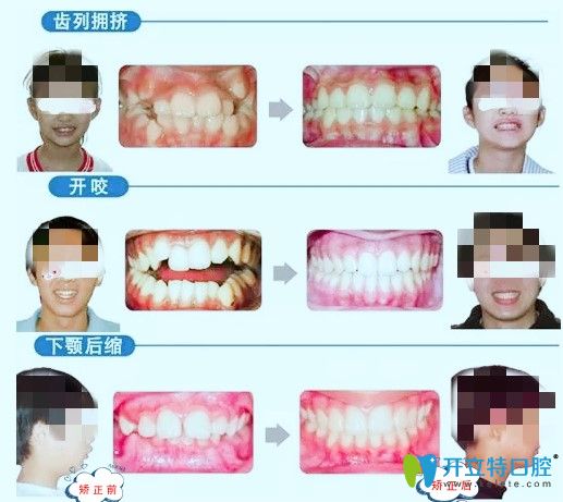 長沙中諾口腔青少年牙齒矯正案例