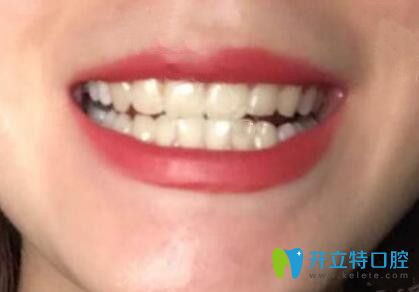 我在廣州壹加壹口腔做牙齒矯正戴保持器